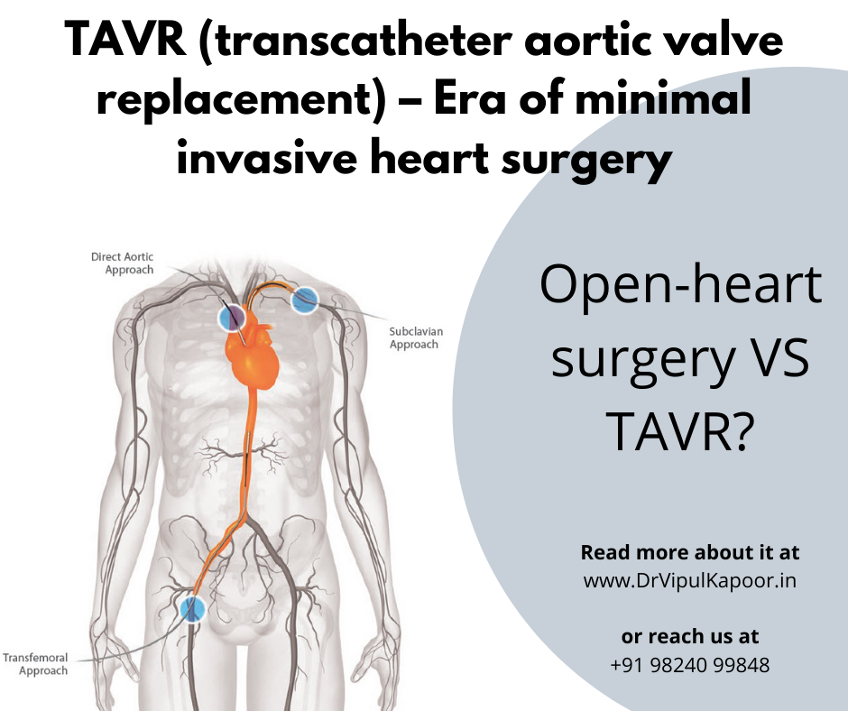 Tavr Transcatheter Aortic Valve Replacement Era Of Minimal